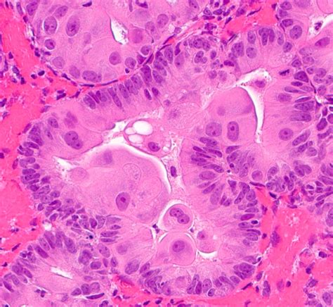 icd 10 tubal metaplasia of endometrium