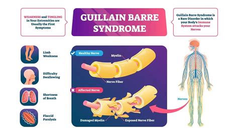 icd code for gbs