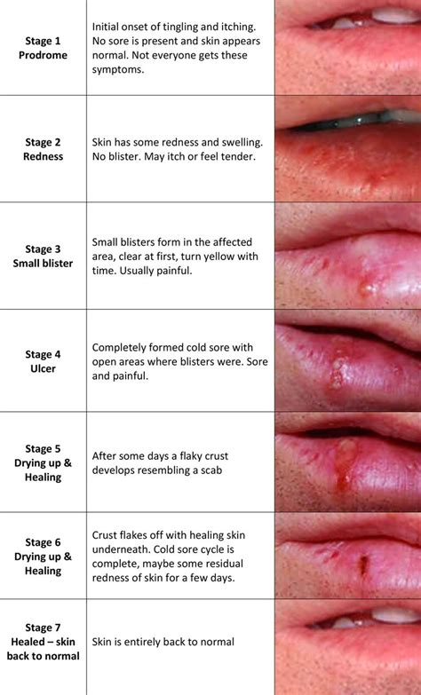 icd code for herpes labialis