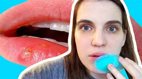 Does Ice on Cold Sore Really Speed Up Healing?
