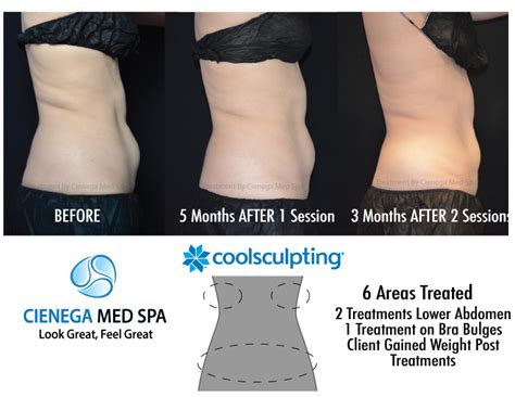 ideal image prices coolsculpting