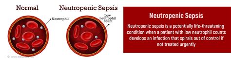 if neutropenic sepsis is suspected