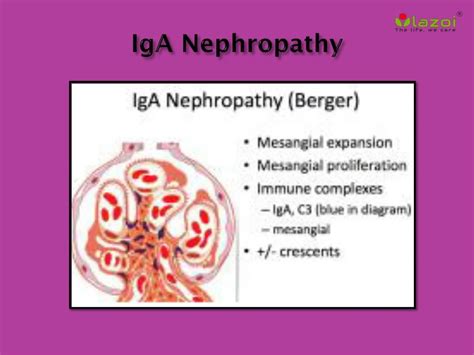 iga nephropathy causes