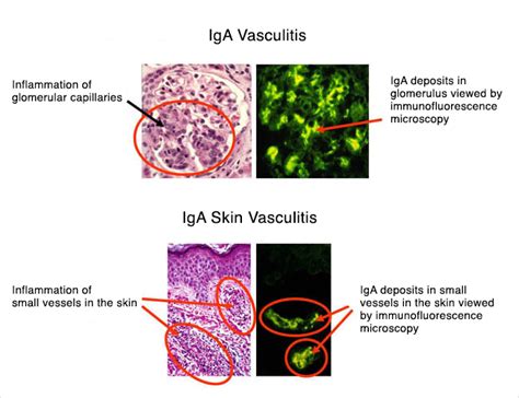 iga vasculitis vs hsp