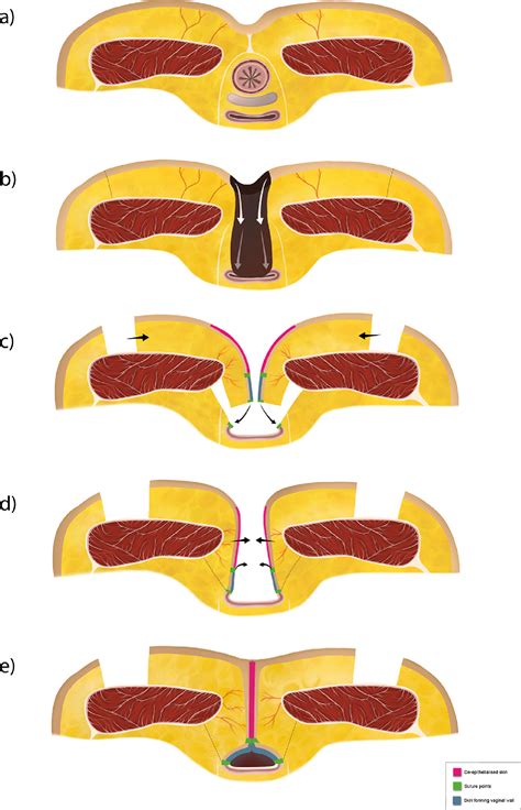 igap flap perineal reconstruction