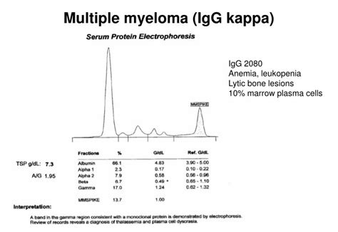 igg kappa smoldering multiple myeloma icd 10
