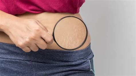 Mencegah Stretch Mark