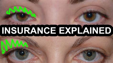 Images Of Eyelid Surgery Covered By Insurance