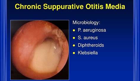Otitis Media With Effusion Glue Ear Symptoms Causes Treatment