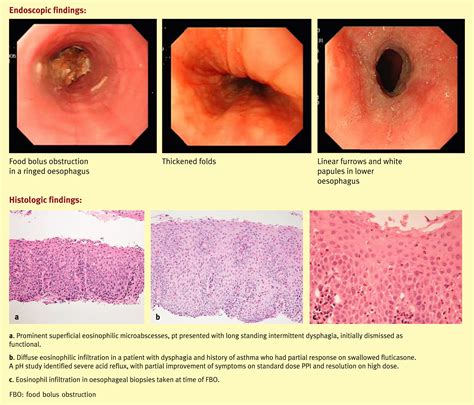 images of eosinophilic esophagitis