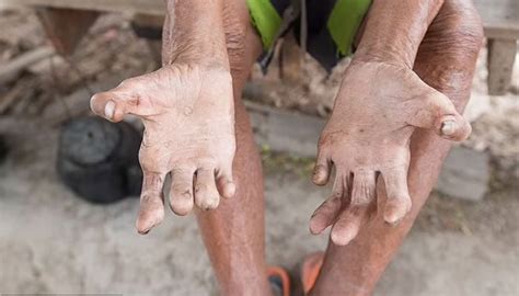 images of leprosy in florida