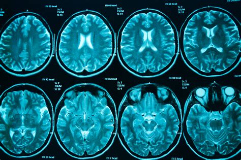 Imaging Examples Brain