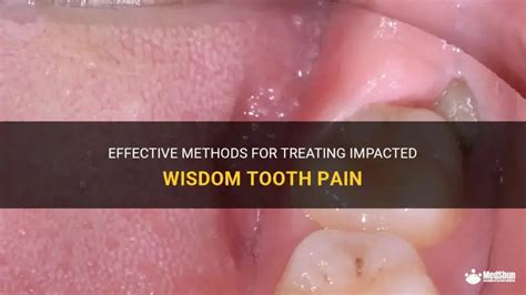 impacted wisdom tooth pain