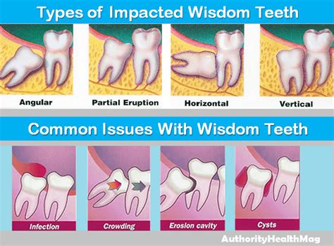 impacted wisdom tooth removal cost