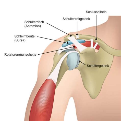 impingement-syndrom schulter