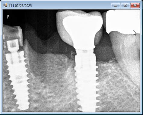 Implant Bridge Abutment Code