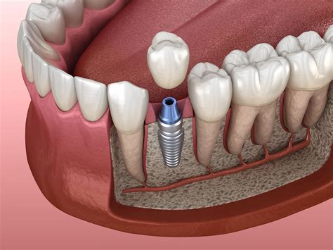 implant for one tooth