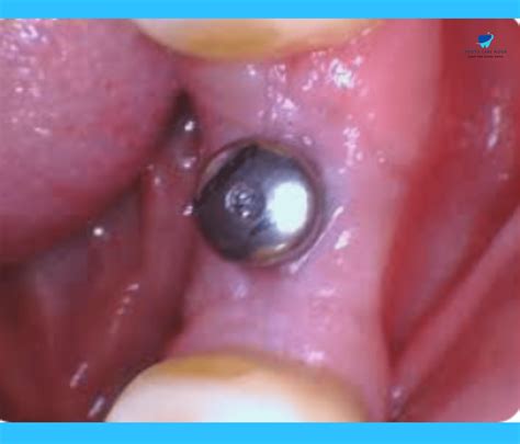 Implant Healing Cap Code