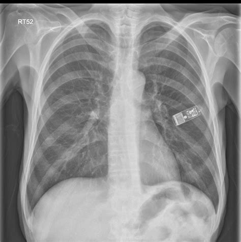 Implantable Loop Recorder X Ray