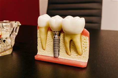 implantes dentales en monterrey