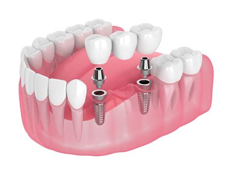 implants for multiple teeth