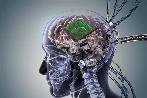 implants in the brain