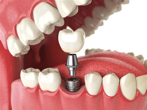 Everything You Need To Know About Dental Implants Regency Square Dental