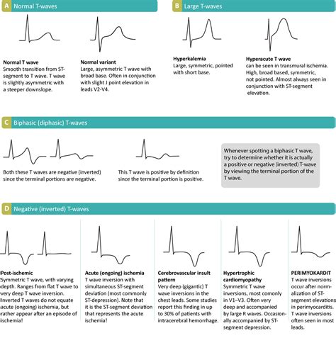 ECG Interpretation ECG Blog 59 — Giant T Ischemia Yamaguchi
