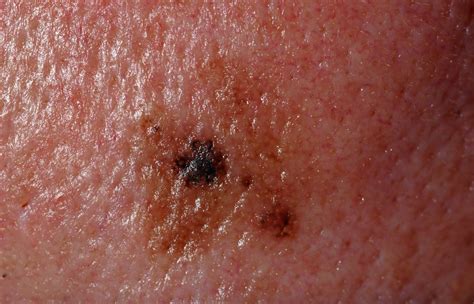 in situ melanoma skin cancer