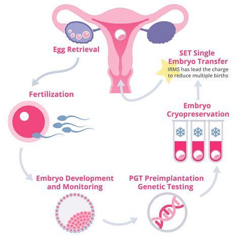 in vitro fertilization process steps