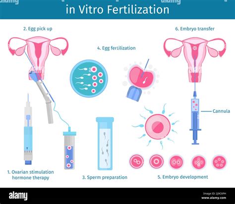 in vitro fertilization steps and alternatives