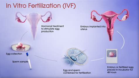 in vitro fertilization treatment
