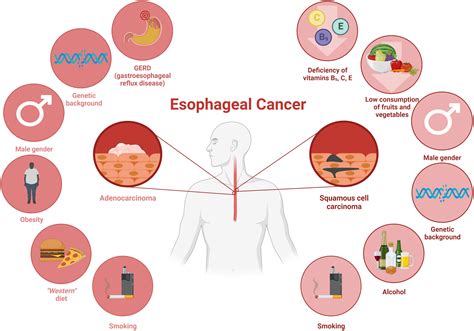 increase in esophageal cancer