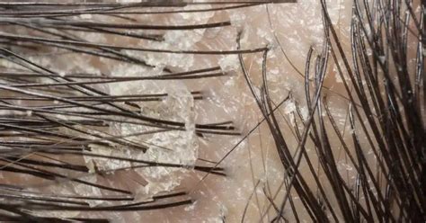 Increased Scalp Visibility