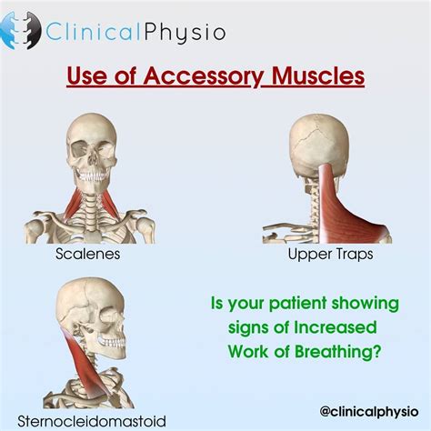 Increased Use of Accessory Muscles