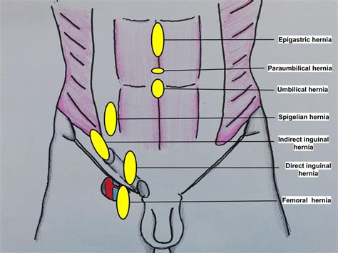 indirect inguinal hernia location
