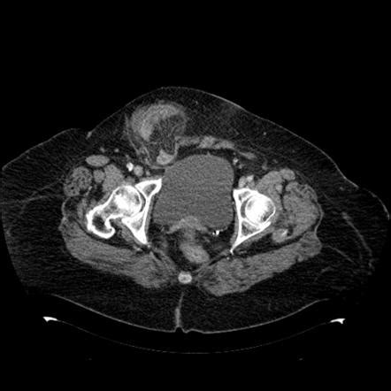 indirect inguinal hernia radiology