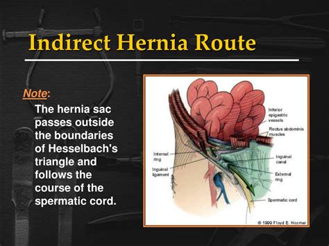 indirect inguinal hernia sac