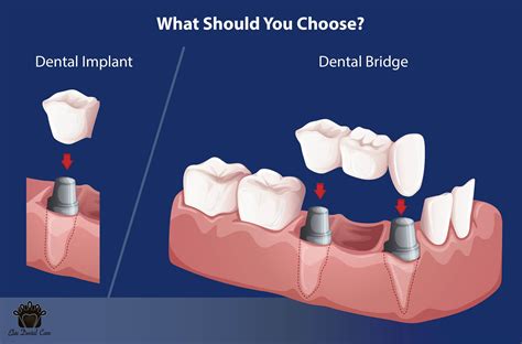 individual implants vs implant bridge