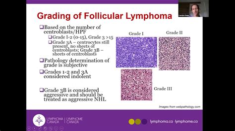 indolent follicular lymphoma staging