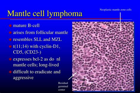 indolent mantle cell lymphoma