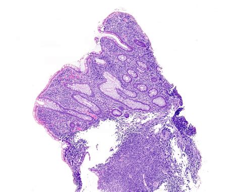 indolent t cell lymphoma