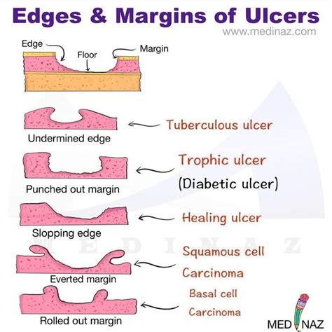 indurated wound edges definition