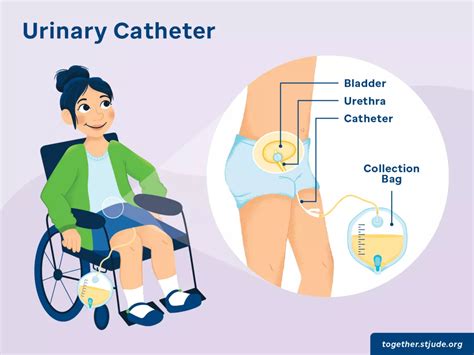 Managing Urinary Retention with an Indwelling Foley Catheter