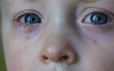 Understanding Infant Eye Discharge: Causes, Symptoms, and Effective Treatments