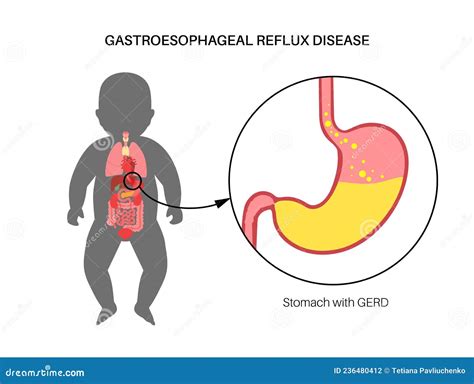 Understanding Infant GERD Symptoms: What Parents Need to Know