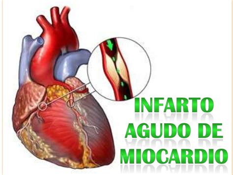 infarto agudo del miocardio ppt