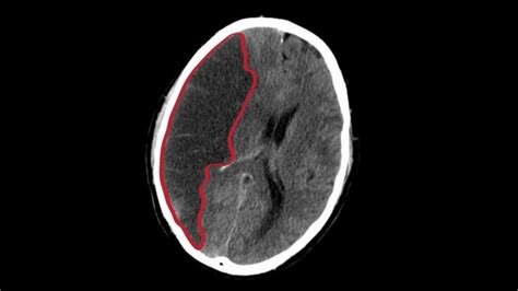 infarto cerebral cie 10