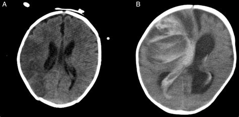 infarto cerebral radiopedia