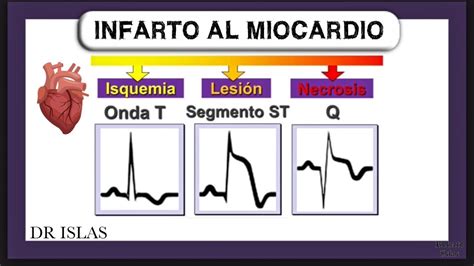 infarto de miocardio sin onda q
